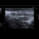 Crohn's disease of terminal ileum: US - Ultrasound